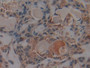 DAB staining on IHC-P; Samples: Human Lung cancer Tissue; Primary Ab: 10µg/ml Rabbit Anti-Human PKCi Antibody Second Ab: 2µg/mL HRP-Linked Caprine Anti-Rabbit IgG Polyclonal Antibody