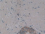 DAB staining on IHC-P; Samples: Human Prostate Tissue; Primary Ab: 10µg/ml Rabbit Anti-Human KRT3 Antibody Second Ab: 2µg/mL HRP-Linked Caprine Anti-Rabbit IgG Polyclonal Antibody