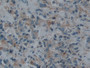 DAB staining on IHC-P; Samples: Human Prostate cancer Tissue; Primary Ab: 10µg/ml Rabbit Anti-Human ECE1 Antibody Second Ab: 2µg/mL HRP-Linked Caprine Anti-Rabbit IgG Polyclonal Antibody