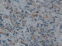 DAB staining on IHC-P; Samples: Human Prostate cancer Tissue)