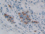 DAB staining on IHC-P; Samples: Human Pancreatic cancer Tissue; Primary Ab: 10µg/ml Rabbit Anti-Human iPLA2 Antibody Second Ab: 2µg/mL HRP-Linked Caprine Anti-Rabbit IgG Polyclonal Antibody