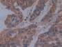 DAB staining on fromalin fixed paraffin- embedded breast cancer tissue)