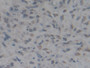 DAB staining on IHC-P; Samples: Human Lung cancer Tissue; Primary Ab: 10µg/ml Rabbit Anti-Human HMG1 Antibody Second Ab: 2µg/mL HRP-Linked Caprine Anti-Rabbit IgG Polyclonal Antibody