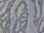 DAB staining on IHC-P; Samples: Human Rectum Cancer Tissue.