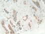 DAB staining on IHC-P; Samples: Human Breast cancer Tissue; Primary Ab: 10µg/ml Rabbit Anti-Human HMG1 Antibody Second Ab: 2µg/mL HRP-Linked Caprine Anti-Rabbit IgG Polyclonal Antibody
