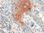 DAB staining on IHC-P; Samples: Human Skin cancer Tissue;  Primary Ab: 10µg/ml Rabbit Anti-Human FS