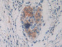 DAB staining on IHC-P; Samples: Human Pancreatic cancer Tissue; Primary Ab: 10µg/ml Rabbit Anti-Human PKIg Antibody Second Ab: 2µg/mL HRP-Linked Caprine Anti-Rabbit IgG Polyclonal Antibody