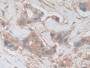 DAB staining on IHC-P; Samples: Human Breast cancer Tissue; Primary Ab: 10µg/ml Rabbit Anti-Human PKBg Antibody Second Ab: 2µg/mL HRP-Linked Caprine Anti-Rabbit IgG Polyclonal Antibody