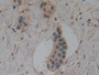 DAB staining on IHC-P; Samples: Human Breast cancer Tissue; Primary Ab: 10µg/ml Rabbit Anti-Human GS Antibody Second Ab: 2µg/mL HRP-Linked Caprine Anti-Rabbit IgG Polyclonal Antibody