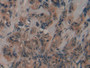 DAB staining on IHC-P; Samples: Human Breast cancer Tissue