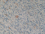 DAB staining on IHC-P; Samples: Human Glioma Tissue;  Primary Ab: 10µg/ml Rabbit Anti-Human UST2 Ant