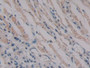 DAB staining on IHC-P; Samples: Human Stomach cancer Tissue; Primary Ab: 10µg/ml Rabbit Anti-Human PKIb Antibody Second Ab: 2µg/mL HRP-Linked Caprine Anti-Rabbit IgG Polyclonal Antibody