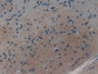 DAB staining on IHC-P; Samples: Human Colorectal cancer Tissue; Primary Ab: 20µg/ml Rabbit Anti-Human CTSA Antibody Second Ab: 2µg/mL HRP-Linked Caprine Anti-Rabbit IgG Polyclonal Antibody