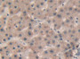DAB staining on IHC-P; Samples: Human Liver cancer Tissue; Primary Ab: 20µg/ml Rabbit Anti-Human Sp100 Antibody Second Ab: 2µg/mL HRP-Linked Caprine Anti-Rabbit IgG Polyclonal Antibody