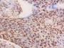 DAB staining on IHC-P; Samples: Human Esophagus Cancer Tissue.