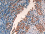 DAB staining on IHC-P; Samples: Human Thyroid cancer Tissue; Primary Ab: 20µg/ml Rabbit Anti-Human GAL2 Antibody Second Ab: 2µg/mL HRP-Linked Caprine Anti-Rabbit IgG Polyclonal Antibody