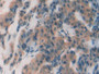 DAB staining on IHC-P; Samples: Human Breast Cancer Tissue.