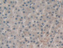 DAB staining on IHC-P; Samples: Human Liver cancer Tissue; Primary Ab: 20µg/ml Rabbit Anti-Human RNASE1 Antibody Second Ab: 2µg/mL HRP-Linked Caprine Anti-Rabbit IgG Polyclonal Antibody