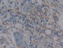 DAB staining on IHC-P; Samples: Human Breast cancer Tissue; Primary Ab: 10µg/ml Rabbit Anti-Human GPX1 Antibody Second Ab: 2µg/mL HRP-Linked Caprine Anti-Rabbit IgG Polyclonal Antibody