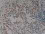 DAB staining on IHC-P; Samples: Human Lung Cancer Tissue.