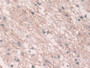 DAB staining on IHC-P; Samples: Human Glioma Tissue