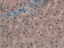 DAB staining on IHC-P; Samples: Human Liver cancer Tissue; Primary Ab: 20µg/ml Rabbit Anti-Human TNPO1 Antibody Second Ab: 2µg/mL HRP-Linked Caprine Anti-Rabbit IgG Polyclonal Antibody