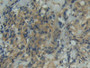 DAB staining on IHC-P; Samples: Human Breast cancer Tissue; Primary Ab: 20µg/ml Rabbit Anti-Human ITGaD Antibody Second Ab: 2µg/mL HRP-Linked Caprine Anti-Rabbit IgG Polyclonal Antibody