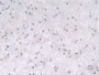 DAB staining on IHC-P; Samples: Human Glioma Tissue.