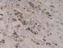 DAB staining on IHC-P; Samples:C.Human Breast Cancer Tissue.