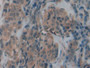 DAB staining on IHC-P; Samples: Human Breast cancer Tissue; Primary Ab: 20µg/ml Rabbit Anti-Human TFR2 Antibody Second Ab: 2µg/mL HRP-Linked Caprine Anti-Rabbit IgG Polyclonal Antibody