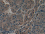 DAB staining on IHC-P; Samples: Human Liver cancer Tissue; Primary Ab: 20µg/ml Rabbit Anti-Human APOC1 Antibody Second Ab: 2µg/mL HRP-Linked Caprine Anti-Rabbit IgG Polyclonal Antibody