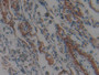 DAB staining on IHC-P; Samples: Human Lung cancer Tissue; Primary Ab: 10µg/ml Rabbit Anti-Human NISCH Antibody Second Ab: 2µg/mL HRP-Linked Caprine Anti-Rabbit IgG Polyclonal Antibody