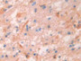 DAB staining on IHC-P; Samples: Human Glioma Tissue; Primary Ab: 30µg/ml Rabbit Anti-Human IgG4 Antibody Second Ab: 2µg/mL HRP-Linked Caprine Anti-Rabbit IgG Polyclonal Antibody