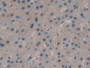 DAB staining on IHC-P; Samples: Human Liver cancer Tissue; Primary Ab: 20µg/ml Rabbit Anti-Human PRSS1 Antibody Second Ab: 2µg/mL HRP-Linked Caprine Anti-Rabbit IgG Polyclonal Antibody