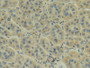 DAB staining on IHC-P; Samples: Human Liver cancer Tissue; Primary Ab: 20µg/ml Rabbit Anti-Human AMH Antibody Second Ab: 2µg/mL HRP-Linked Caprine Anti-Rabbit IgG Polyclonal Antibody