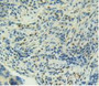 DAB staining on IHC-P; Samples: Human Rectum Cancer Tissue.