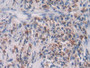DAB staining on IHC-P; Samples: Human Lung Cancer Tissue