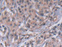 DAB staining on IHC-P; Samples: Human Breast cancer Tissue; Primary Ab: 30µg/ml Rabbit Anti-Human MMP23B Antibody Second Ab: 2µg/mL HRP-Linked Caprine Anti-Rabbit IgG Polyclonal Antibody