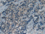 DAB staining on IHC-P; Samples: Human Thyroid cancer Tissue