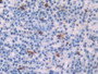 DAB staining on IHC-P; Samples: Human Skin Cancer Tissue