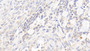 DAB staining on IHC-P; Samples: Human Ovarian cancer Tissue;  Primary Ab: 20μg/ml Rabbit Anti-Human PTGES Antibody Second Ab: 2µg/mL HRP-Linked Caprine Anti-Rabbit IgG Polyclonal Antibody 