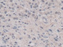 DAB staining on IHC-P; Samples: Human Prostate cancer Tissue; Primary Ab: 20µg/ml Rabbit Anti-Human PGC Antibody Second Ab: 2µg/mL HRP-Linked Caprine Anti-Rabbit IgG Polyclonal Antibody