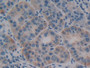 DAB staining on IHC-P; Samples: Human Liver cancer Tissue; Primary Ab: 20µg/ml Rabbit Anti-Human OLFM4 Antibody Second Ab: 2µg/mL HRP-Linked Caprine Anti-Rabbit IgG Polyclonal Antibody