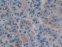 DAB staining on IHC-P; Samples: Human Liver Cancer Tissue