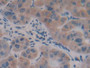 DAB staining on IHC-P; Samples: Human Liver cancer Tissue; Primary Ab: 20µg/ml Rabbit Anti-Human aFP Antibody Second Ab: 2µg/mL HRP-Linked Caprine Anti-Rabbit IgG Polyclonal Antibody