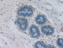 DAB staining on IHC-P; Samples: Human Breast Cancer Tissue