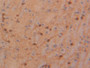 DAB staining on IHC-P; Samples: Rat Glioma Tissue; Primary Ab: 20µg/ml Rabbit Anti-Rat TIMP4 Antibody Second Ab: 2µg/mL HRP-Linked Caprine Anti-Rabbit IgG Polyclonal Antibody