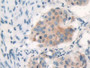 DAB staining on IHC-P; Samples: Human Lung cancer Tissue; Primary Ab: 10µg/ml Rabbit Anti-Human PAR4 Antibody Second Ab: 2µg/mL HRP-Linked Caprine Anti-Rabbit IgG Polyclonal Antibody