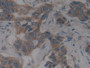 DAB staining on IHC-P; Samples: Human Breast Cancer Tissue