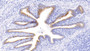DAB staining on IHC-P; Samples: Human Lung Tissue; Primary Ab: 30µg/ml Rabbit Anti-Human MMP2 Antibody Second Ab: 2µg/mL HRP-Linked Caprine Anti-Rabbit IgG Polyclonal Antibody